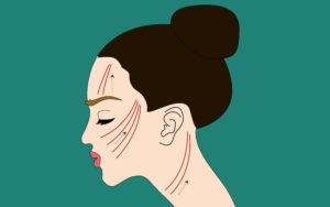 drjed-threadlift-teleme