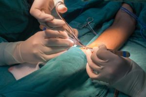 AV Fistula