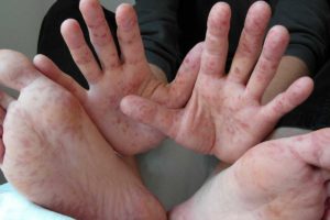 HFMD in a child