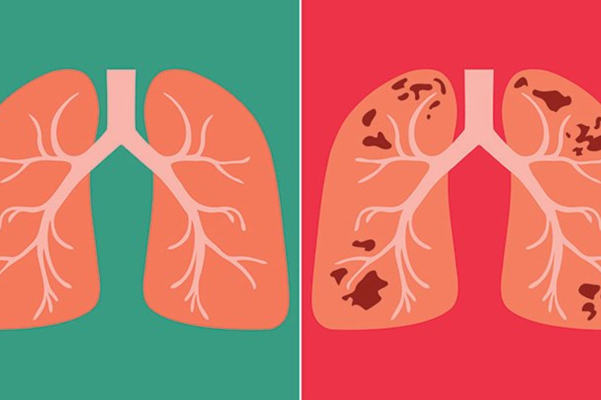 Tuberculosis (TB) of the Lung Tuberculosis (TB) of the Lung