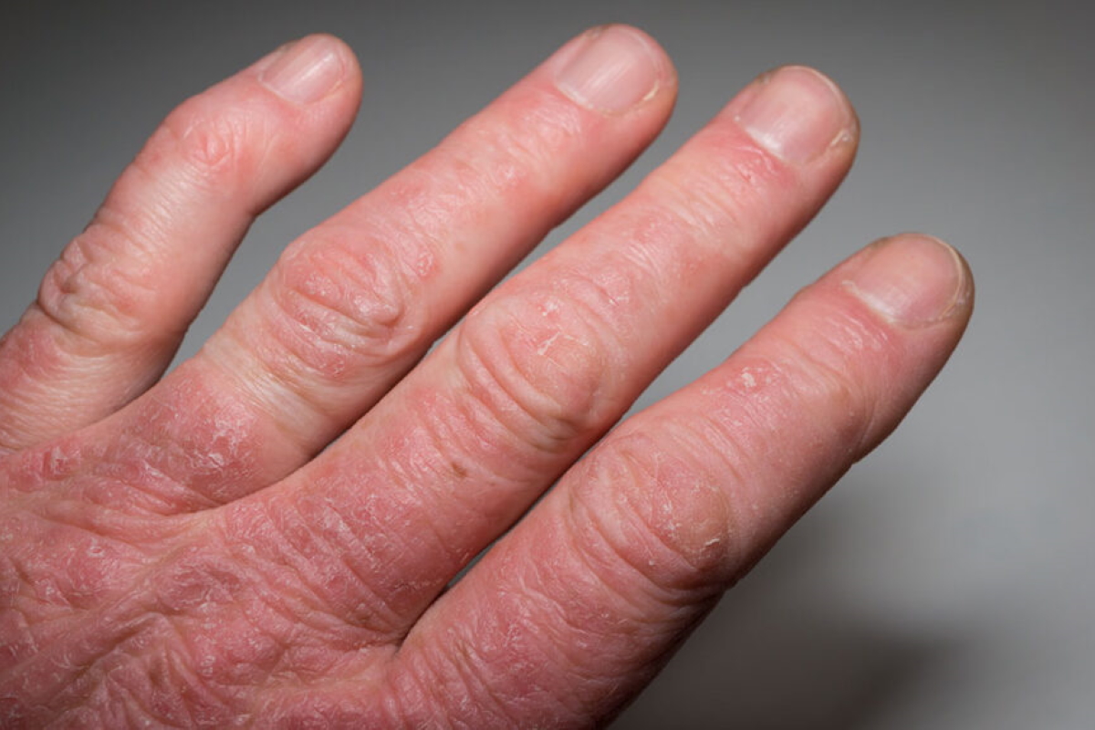 Psoriatic Arthritis
