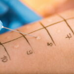 Allergy Skin Tests Allergy Skin Tests