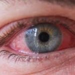 Infective Conjunctivitis (Eye Infection) Infective Conjunctivitis (Eye Infection)
