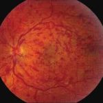 Retinal Vein Occlusion of the Eye Retinal Vein Occlusion of the Eye