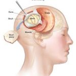 Post-Operative Care after Brain Surgery Post-Operative Care after Brain Surgery