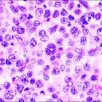 Non-Hodgkin Lymphoma