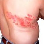 Herpes Zoster Infection / Shingles Herpes Zoster Infection / Shingles